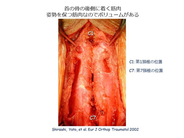 白石脊椎クリニック患者の頚椎の脊柱管狭窄症画像03