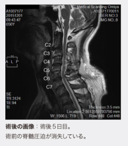 白石脊椎クリニック患者のせ脊髄圧迫画像01