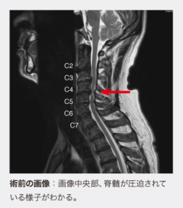 白石脊椎クリニック患者のせ脊髄圧迫画像02