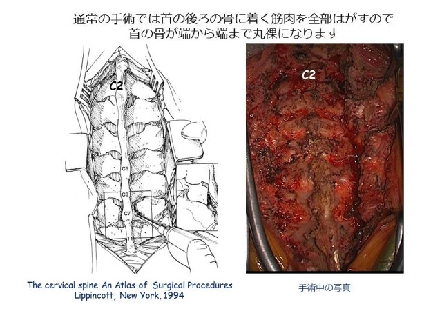 白石脊椎クリニック患者の頚椎の脊柱管狭窄症画像01