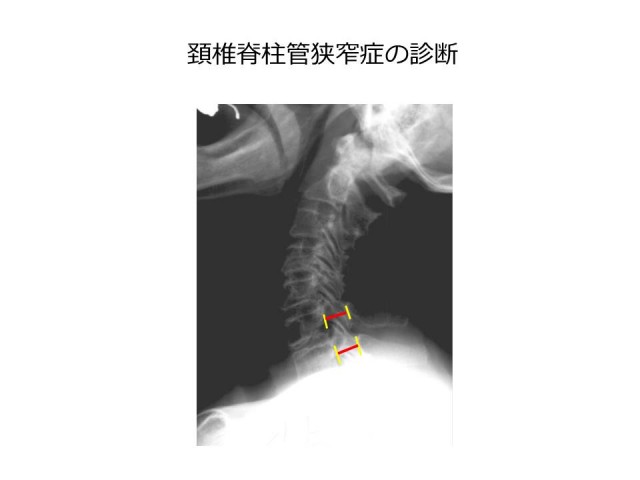 頚椎脊柱管狭窄症画像02