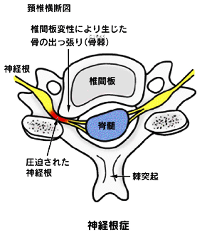 頸椎断面図