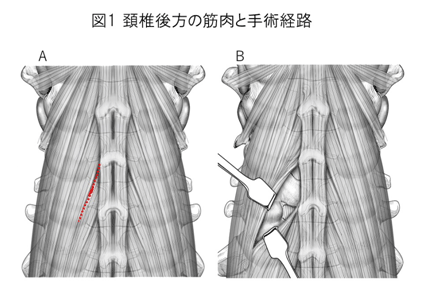 頚椎後方の筋肉と手術経路
