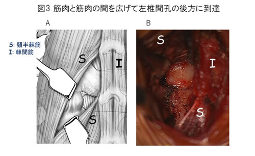 手術画像左椎間孔の後方