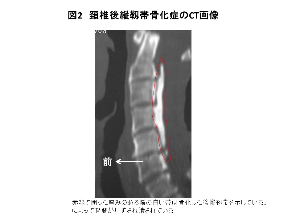 水平断面の頚椎後縦靭帯骨化症