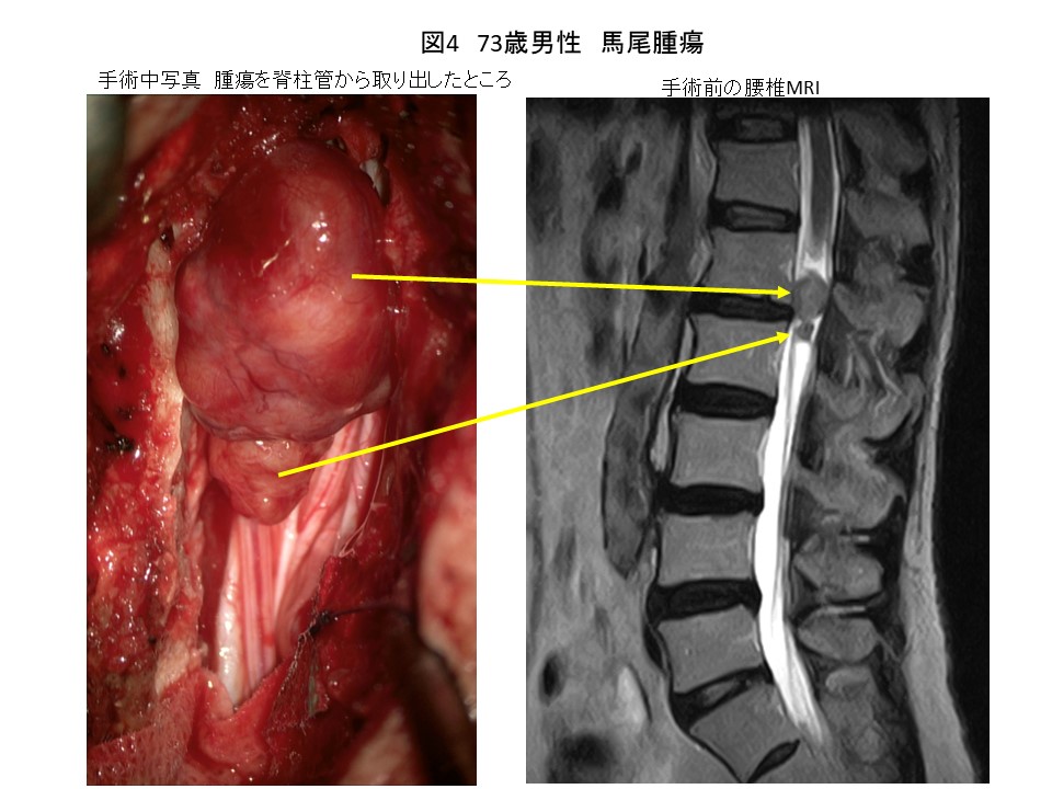 白石脊椎クリニック患者の馬尾腫瘍画像04