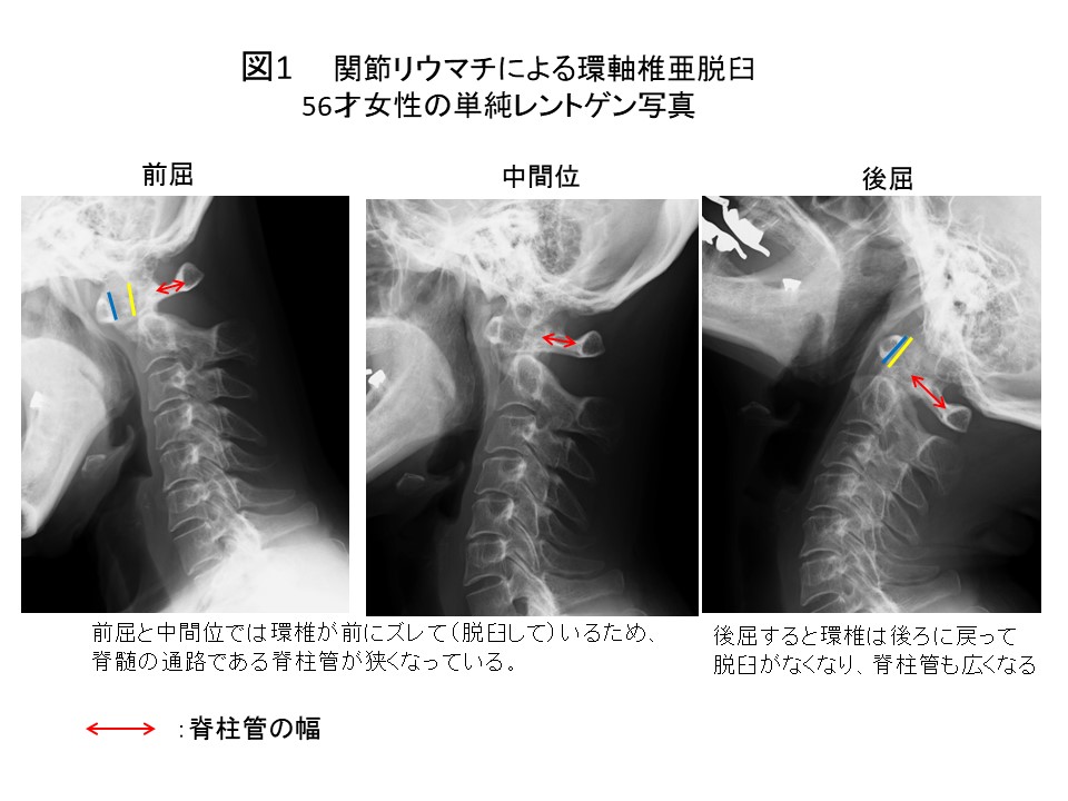 首の骨折の原因