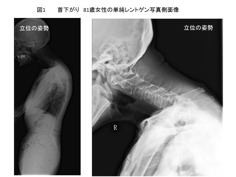 白石脊椎クリニック患者の首下がり症候群の画像01