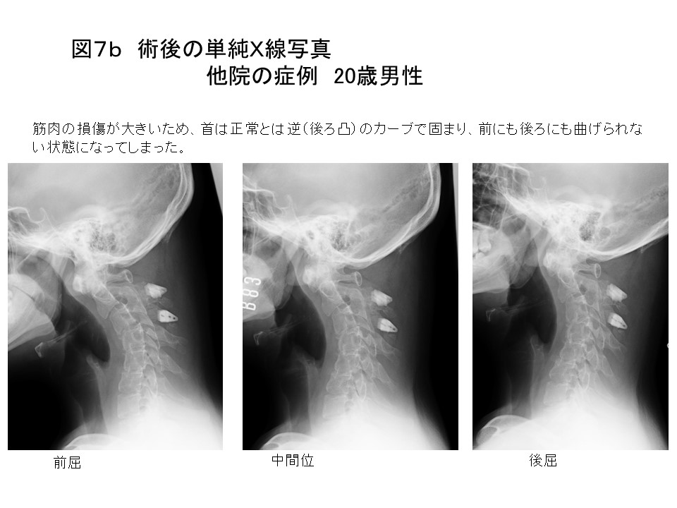 s白石脊椎クリニック患者の頚髄腫瘍画像08