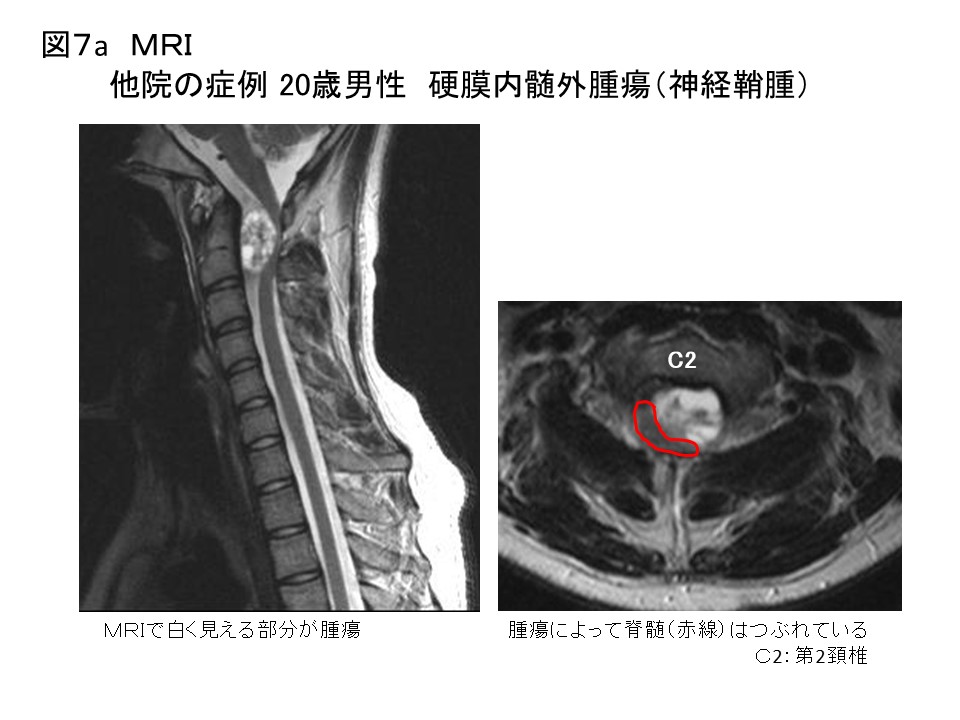 白石脊椎クリニック患者の頚髄腫瘍画像07
