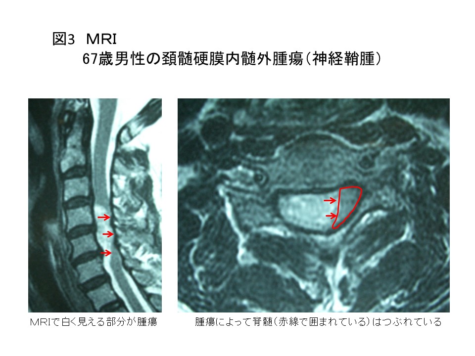白石脊椎クリニック患者の頚髄腫瘍画像03