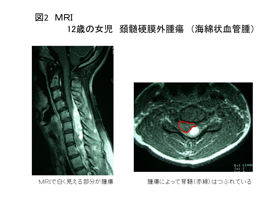 白石脊椎クリニック患者の頚髄腫瘍画像02