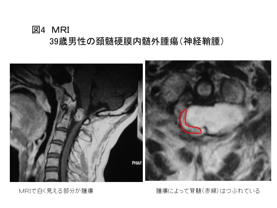 白石脊椎クリニック患者の頚髄腫瘍画像04