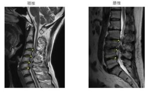 脊椎管狭窄症のMRI