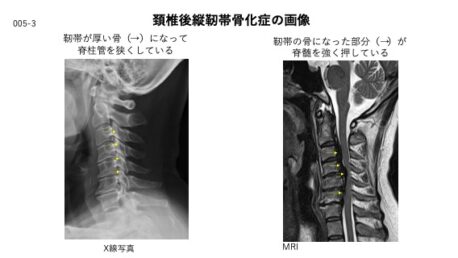 脊柱管狭窄症とは 首が痛いなら白石脊椎クリニック