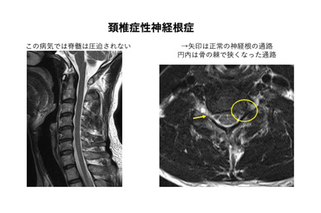 頚椎 症 性 セール 神経 根 症 神戸 枕