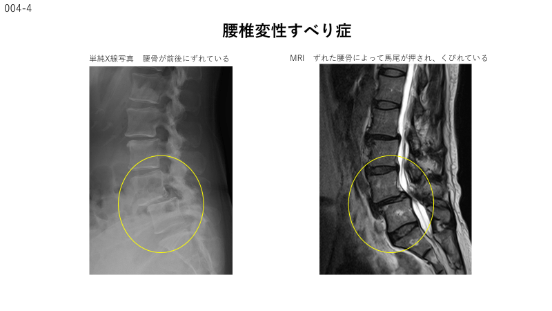 腰部脊柱管狭窄症について
