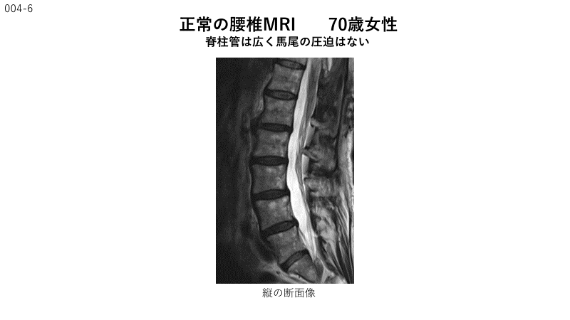 腰部脊柱管狭窄症について