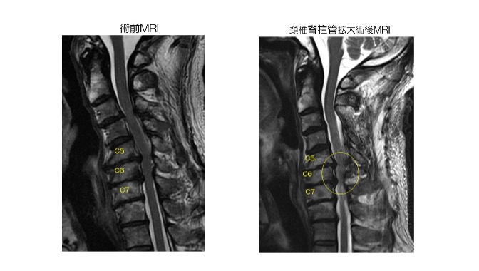 脊椎後弯形成術後の腰痛の管理
