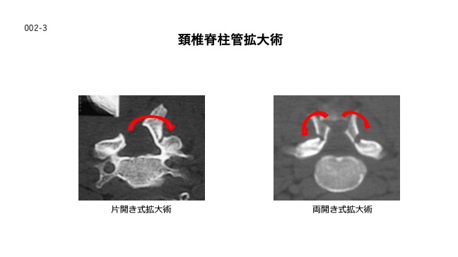 妊娠後の臍形成術