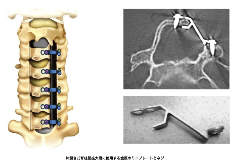 頚椎脊柱管狭窄症手術の問題点